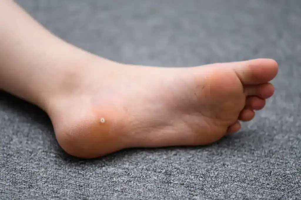 Cryotherapy For Warts And Also Verrucas 2 Image of verruca on the bottom of the foot that able to be treated with Cryotherapy Nuneaton