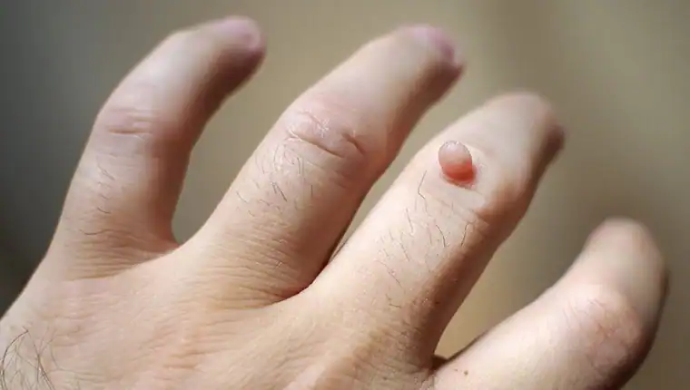Cryotherapy For Warts And Also Verrucas 1 Image of blemish that Cryotherapy Nuneaton can remove with Lipo 360.