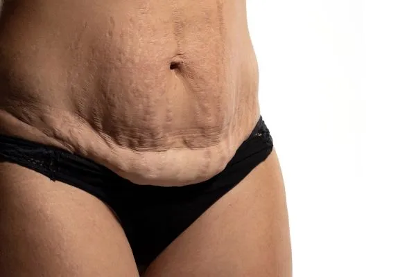 The science behind skin tightening Nuneaton picture of a woman's sagging skin on the stomach